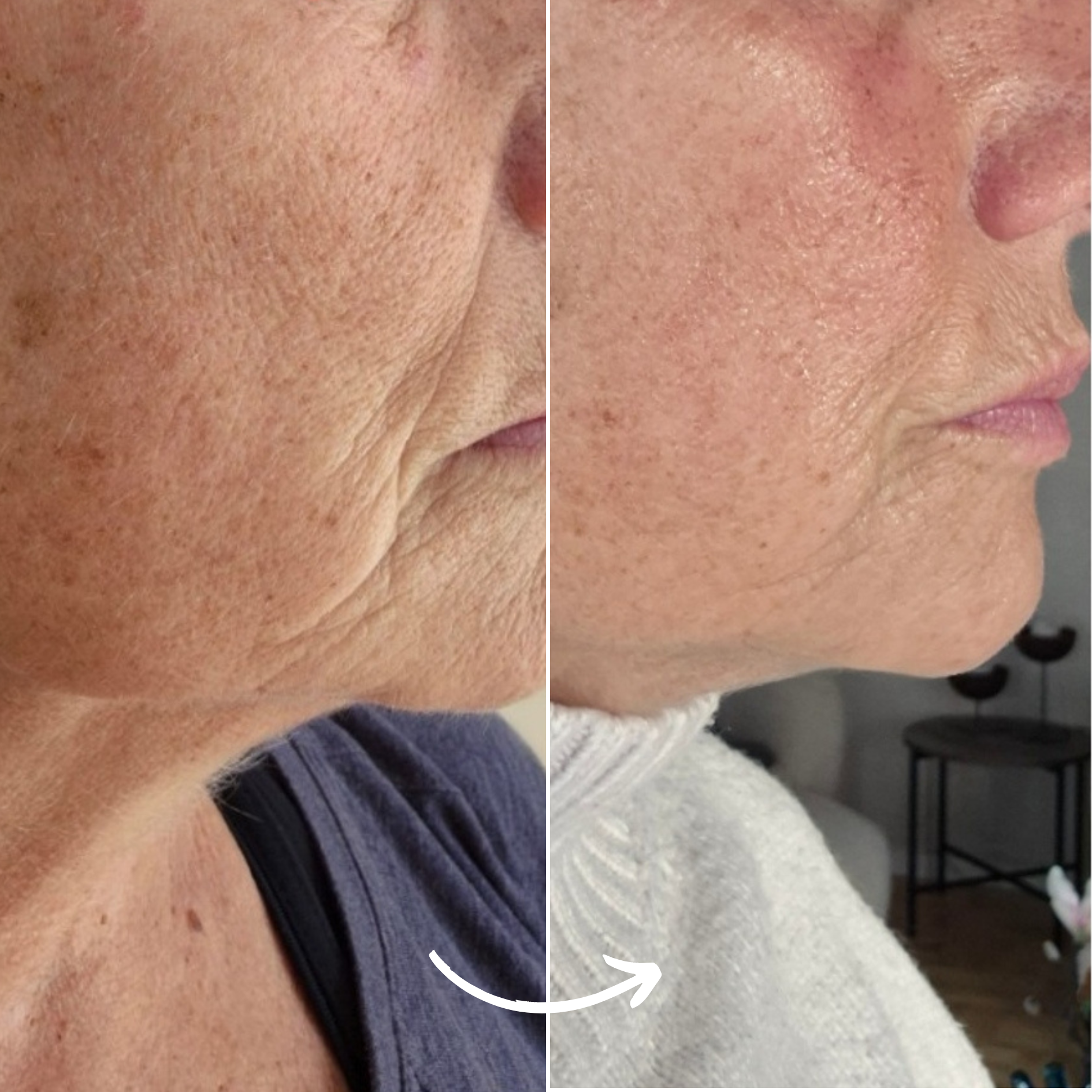SCANDIFACE Skinboosting LED-maske